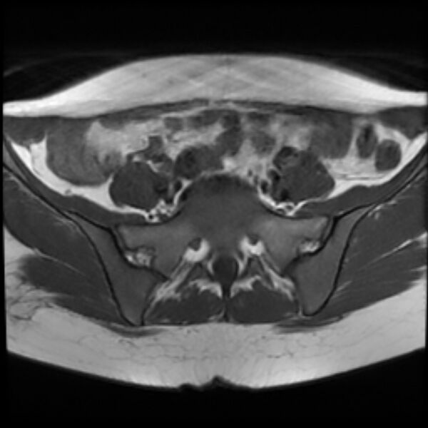 File:Adenomyosis within a septate uterus (Radiopaedia 69963-79981 Axial T1 7).jpg