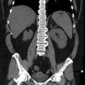 Adrenal myelolipoma (Radiopaedia 8216-9068 non-contrast 10).jpg
