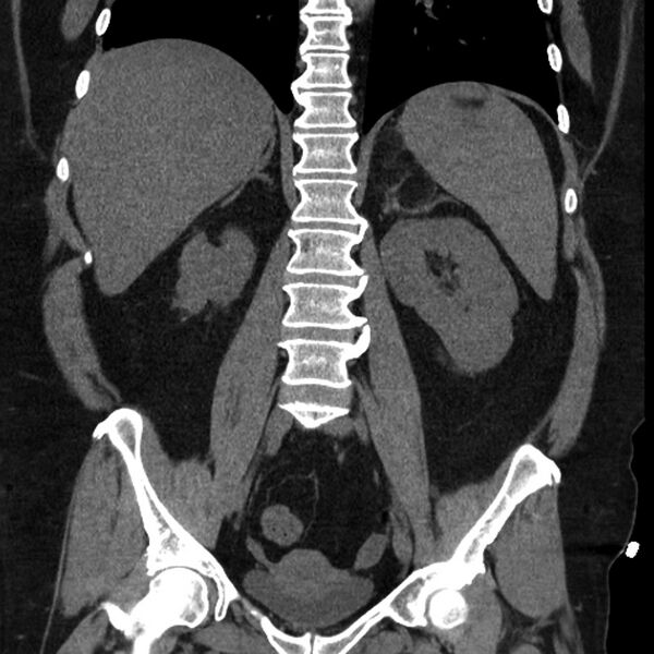 File:Adrenal myelolipoma (Radiopaedia 8216-9068 non-contrast 10).jpg