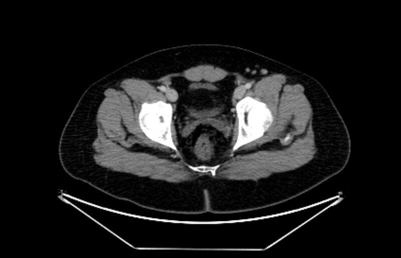 File:Adrenocortical carcinoma (Radiopaedia 80134-93438 Axial C+ portal venous phase 123).jpg