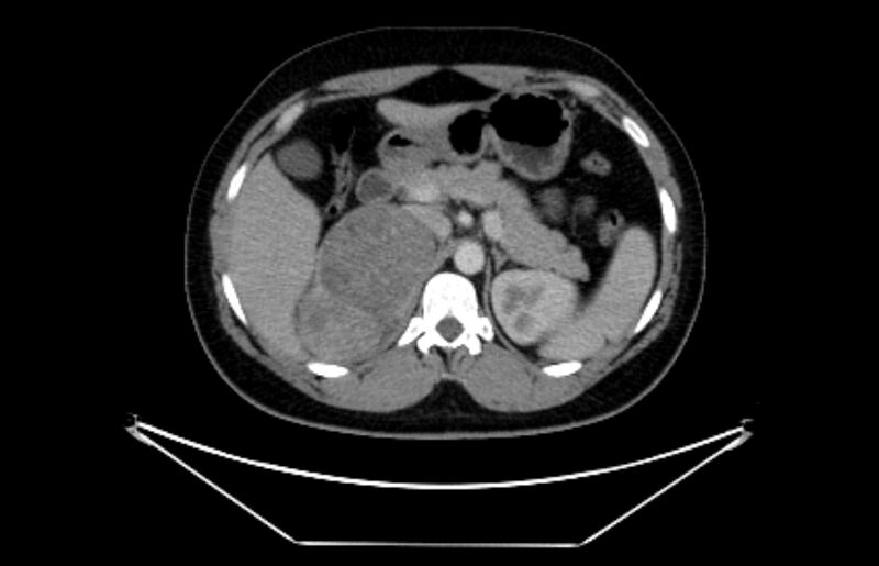 File:Adrenocortical carcinoma (Radiopaedia 80134-93438 Axial C+ portal venous phase 40).jpg