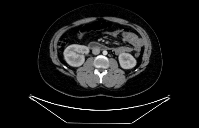 File:Adrenocortical carcinoma (Radiopaedia 80134-93438 Axial C+ portal venous phase 63).jpg