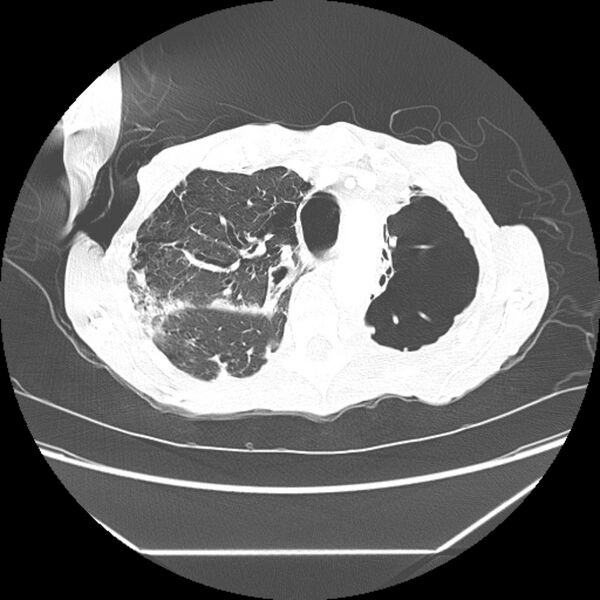 File:Advanced pulmonary tuberculosis (Radiopaedia 8599-9431 Axial lung window 13).jpg