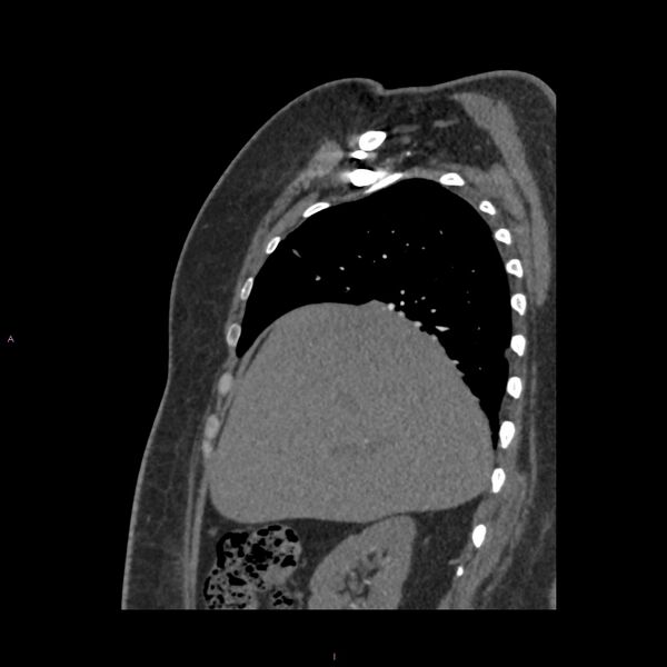 File:Agenesis of the left hepatic lobe (Radiopaedia 77284-89359 Sagittal C+ CTPA 28).jpg