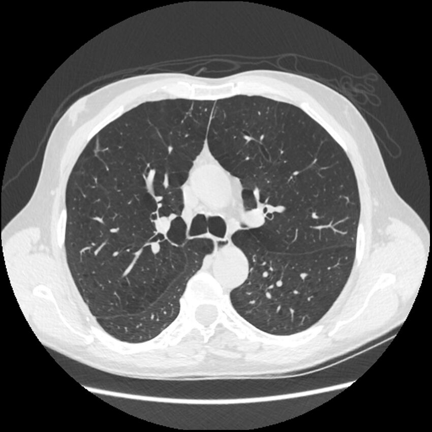 Alpha-1-antitrypsin deficiency (Radiopaedia 40993-43722 Axial lung window 87).jpg