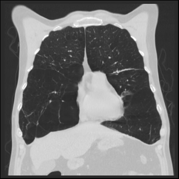 File:Alpha-1-antitrypsin deficiency (Radiopaedia 40993-43722 Coronal lung window 27).jpg