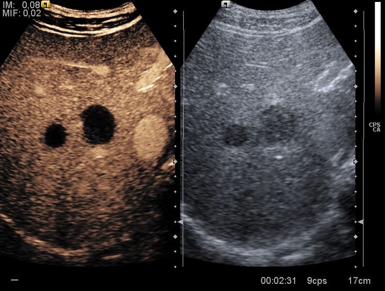 File:Amoebic hepatic abscesses (CEUS) (Radiopaedia 30925-31626 C 1).jpg