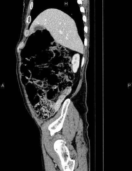 File:Ampullary adenocarcinoma (Radiopaedia 86093-102032 D 16).jpg