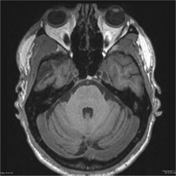 File:Anaplastic meningioma with recurrence (Radiopaedia 34452-35788 Axial T1 34).jpg