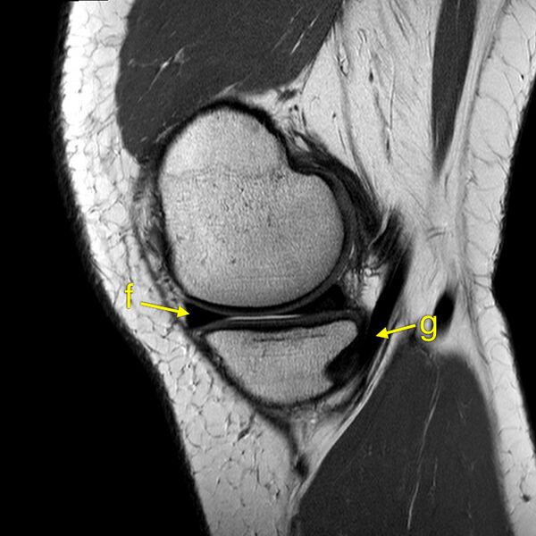 File:Anatomy Quiz (MRI knee) (Radiopaedia 43478-46865 A 5).jpeg