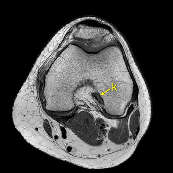 File:Anatomy Quiz (MRI knee) (Radiopaedia 43478-46866 A 12).jpeg