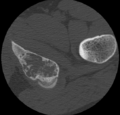 Aneurysmal bone cyst of ischium (Radiopaedia 25957-26094 B 44).png