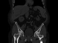 Ankylosing spondylitis (Radiopaedia 44609-48357 Coronal bone window 24).jpg