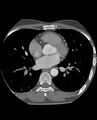 Anomalous coronary arteries (Radiopaedia 83979-99206 A 157).jpg