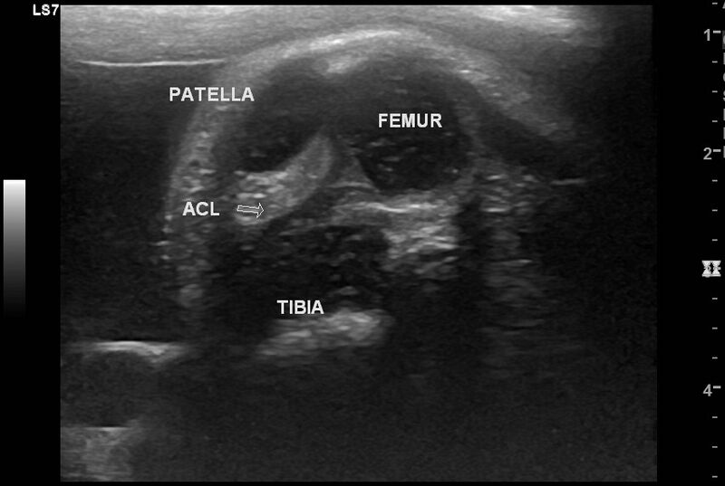 File:Anterior and posterior cruciate ligaments (fetus) (Radiopaedia 82919).jpg