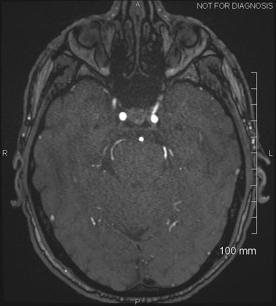 File:Anterior cerebral artery aneurysm (Radiopaedia 80683-94127 Axial MRA 78).jpg