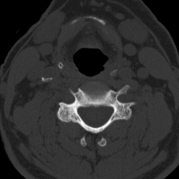 File:Anterior cervical postdiscectomy arthrodesis (Radiopaedia 32678-33646 Axial bone window 41).jpg