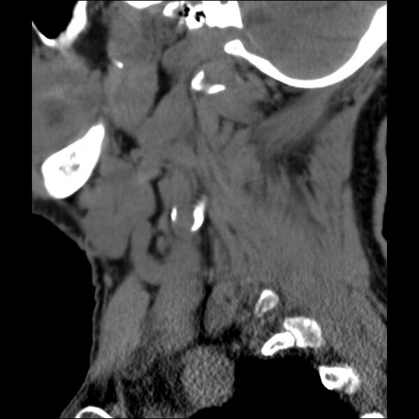 File:Anterior cervical postdiscectomy arthrodesis (Radiopaedia 32678-33646 C 4).jpg