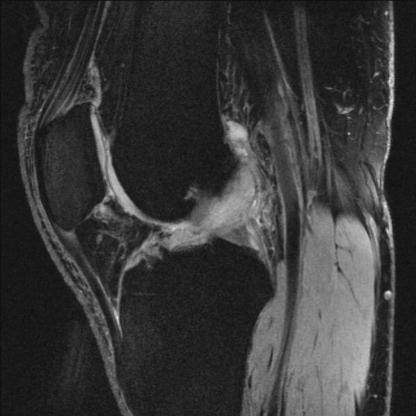File:Anterior cruciate ligament mucoid degeneration (Radiopaedia 68400-77933 Sagittal 29).jpg