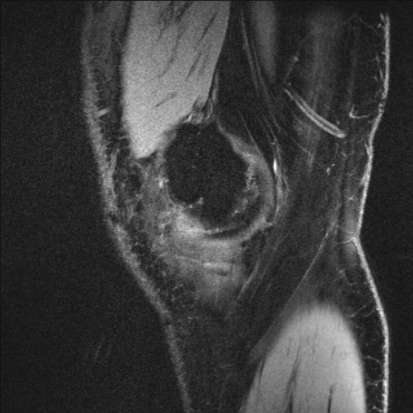 Anterior cruciate ligament mucoid degeneration (Radiopaedia 68400-77933 Sagittal 60).jpg