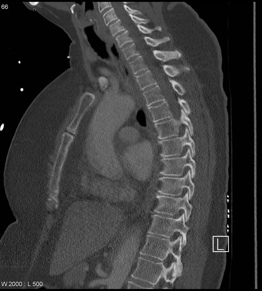 Anterior shoulder dislocation (CT) (Radiopaedia 59032-66309 Sagittal bone window 33).jpg