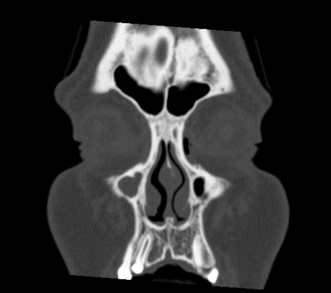 File:Antrochoanal polyp (Radiopaedia 21894-21868 Coronal bone window 4).jpg