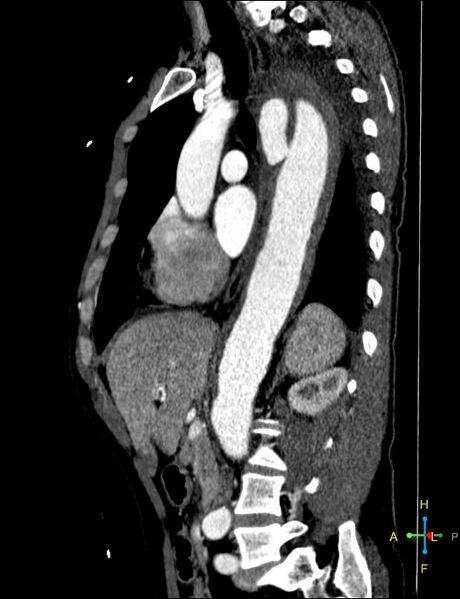 File:Aortic aneurysm and penetrating ulcer (Radiopaedia 23590-23704 C 21).jpg