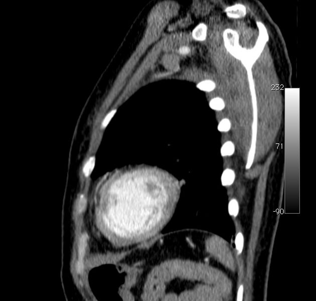 File:Aortic dissection - Stanford type A (Radiopaedia 29247-29659 C 2).jpg
