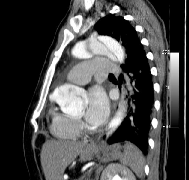File:Aortic dissection - Stanford type A (Radiopaedia 29247-29659 C 20).jpg