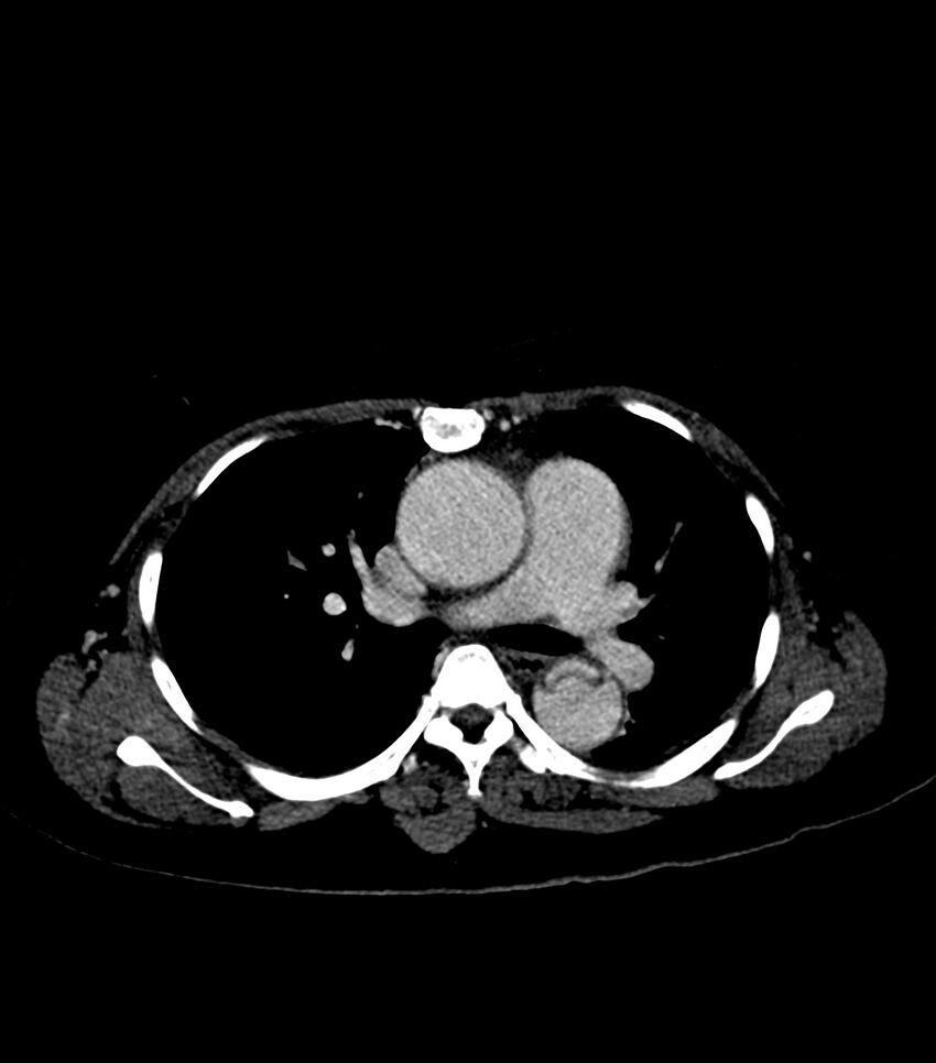 Aortic dissection with renal ischemia (Radiopaedia 76573-88338 B 12).jpg