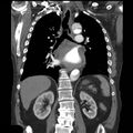 Aortic dissection with rupture into pericardium (Radiopaedia 12384-12647 B 27).jpg