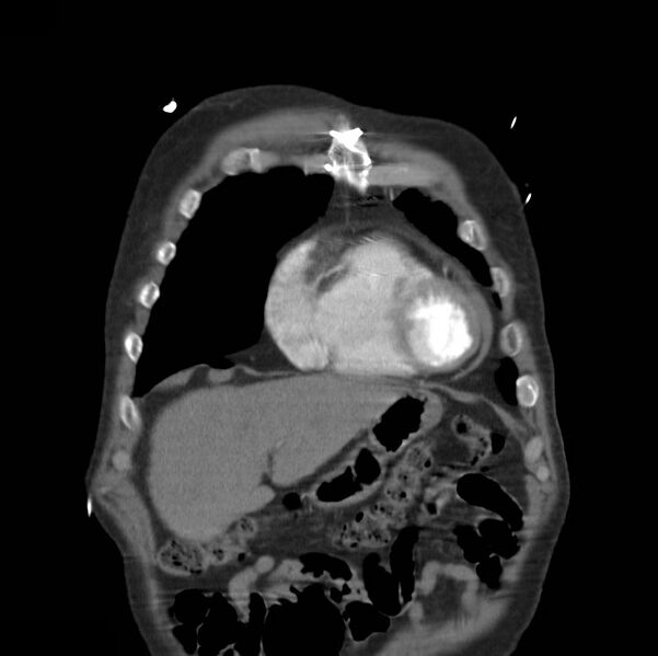 File:Aortic dissection with rupture into pericardium (Radiopaedia 12384-12647 B 5).jpg