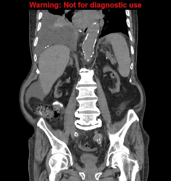 File:Aortic graft infection (Radiopaedia 44979-48907 non-contrast 31).jpg