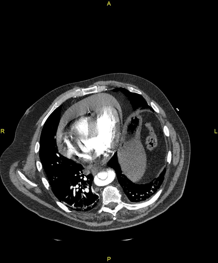 Aortic rupture (Radiopaedia 88822-105594 B 167).jpg