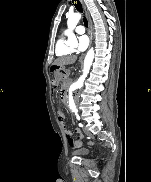 File:Aortoenteric fistula (Radiopaedia 84308-99603 C 192).jpg