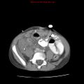 Appendicitis with phlegmon (Radiopaedia 9358-10046 A 47).jpg