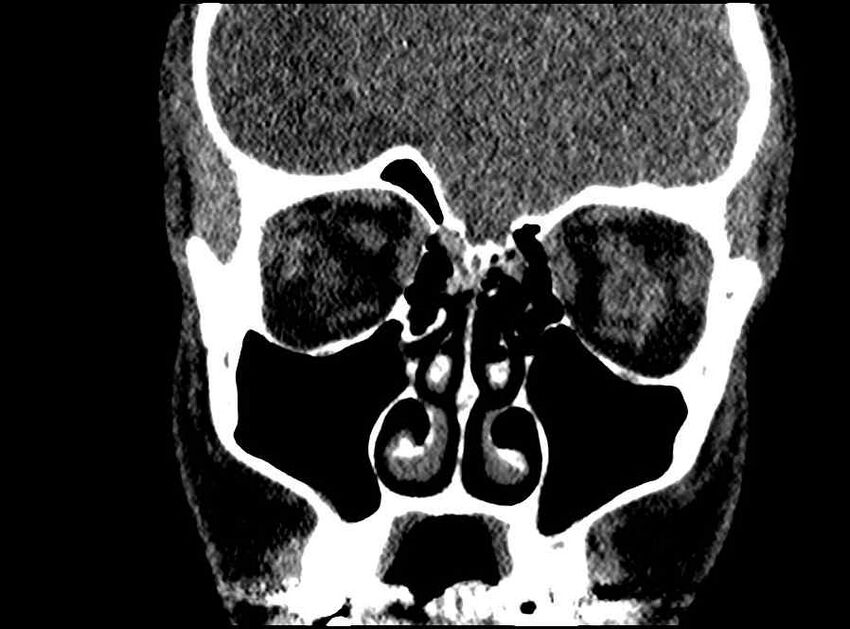 Arachnoid cyst- extremely large (Radiopaedia 68741-78450 Coronal bone window 51).jpg