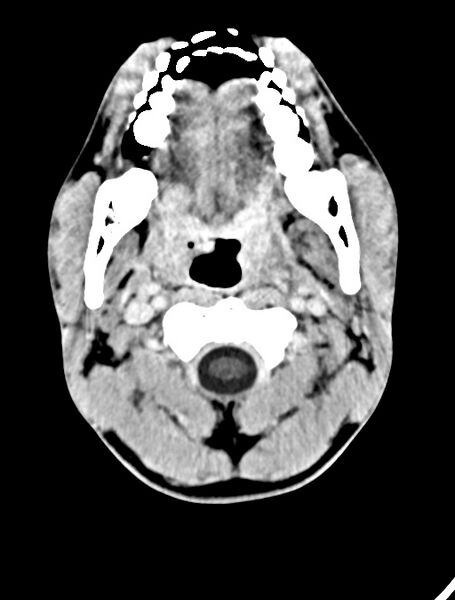 File:Arrow injury to the face (Radiopaedia 73267-84011 Axial C+ delayed 22).jpg