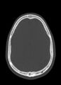 Arrow injury to the head (Radiopaedia 75266-86388 Axial bone window 94).jpg