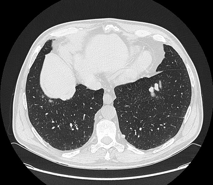 File:Asbestos pleural placques (Radiopaedia 57905-64872 Axial lung window 188).jpg