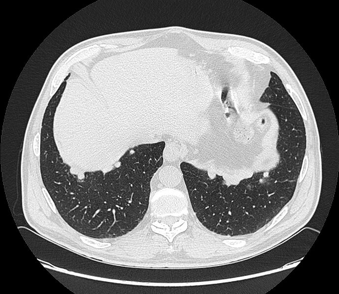 File:Asbestos pleural placques (Radiopaedia 57905-64872 Axial lung window 197).jpg