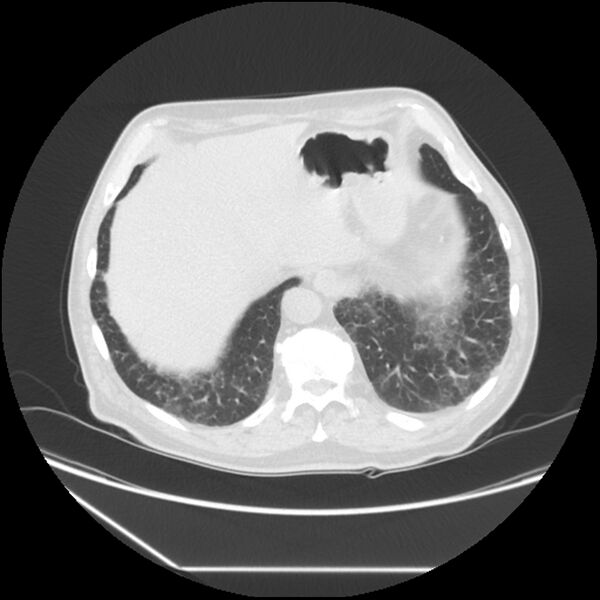File:Asbestosis complicated by lung cancer (Radiopaedia 45834-50116 Axial lung window 58).jpg