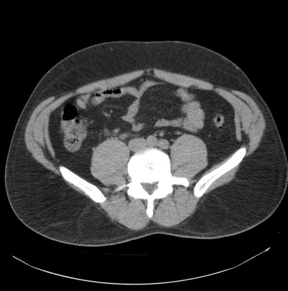 File:Atrophic kidney due to severe chronic obstructive hydronephrosis (Radiopaedia 40828-43474 Axial non-contrast 23).jpg