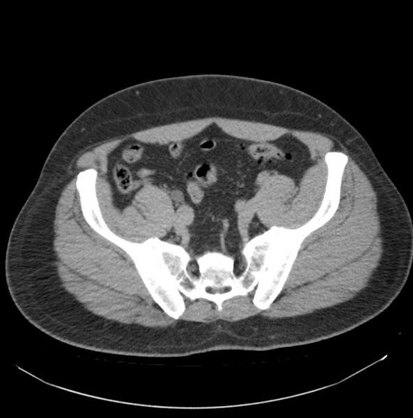 File:Atrophic kidney due to severe chronic obstructive hydronephrosis (Radiopaedia 40828-43474 Axial non-contrast 33).jpg