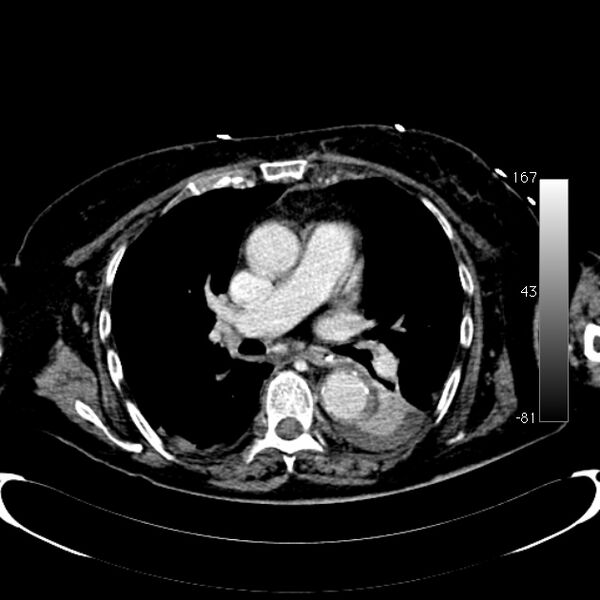 File:Atypical dissection of the thoracic aorta (Radiopaedia 10975-78320 A 30).jpg