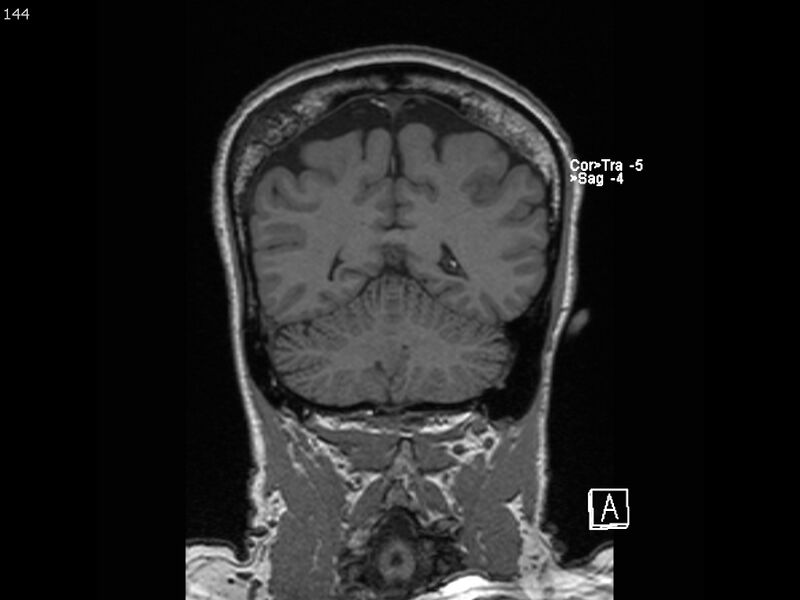 File:Atypical meningioma - intraosseous (Radiopaedia 64915-74572 Coronal T1 144).jpg