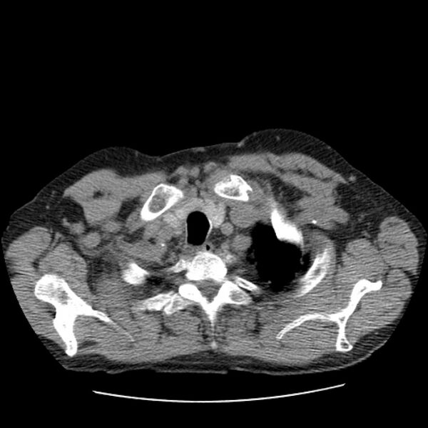 File:Autosomal dominant polycystic kidney disease (Radiopaedia 27851-28094 Axial non-contrast 5).jpg