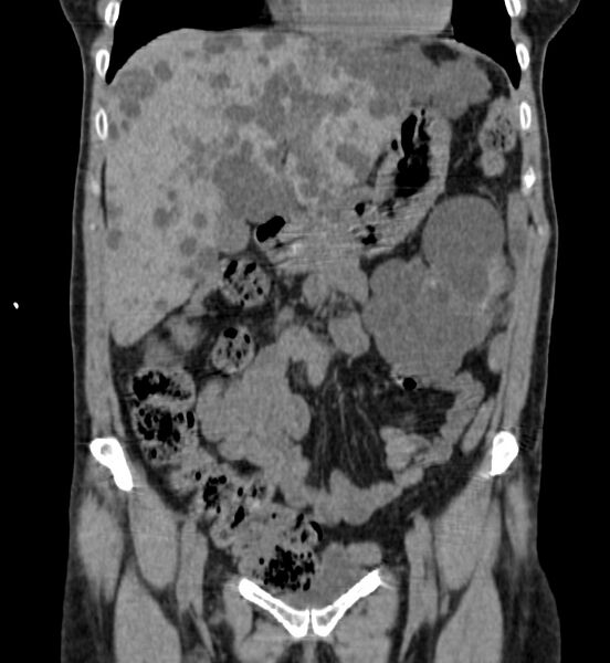 File:Autosomal dominant polycystic kidney disease (Radiopaedia 41918-44922 Coronal non-contrast 7).jpg