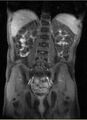 Autosomal recessive polycystic kidney disease (Radiopaedia 11224-11589 Coronal T1 fat sat 1).jpg