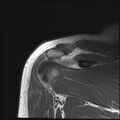 Avulsion fracture - greater tuberosity of humerus (Radiopaedia 71216-81515 Coronal T1 6).jpg